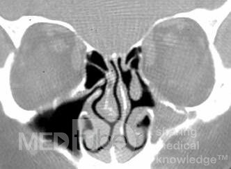 Allergic Fungal Sinusitis
