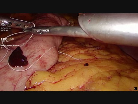 Lap Gastric Plication