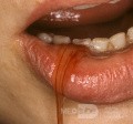 Large Mucocoele Lip Drained