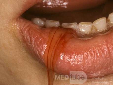 Large Mucocoele Lip Drained