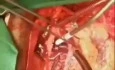 Thrombus Removal from RA