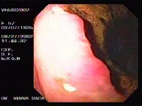 Ulcerative Gastric Adenocarcinoma - Endoscopy