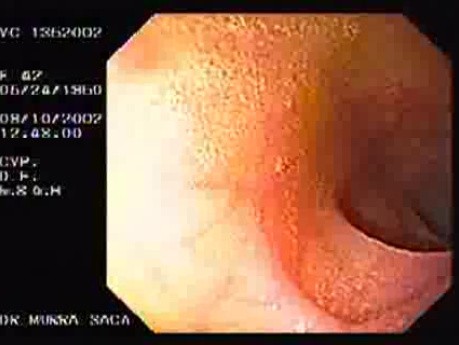 Ileum-transverse Anastomosis (3 of 3)