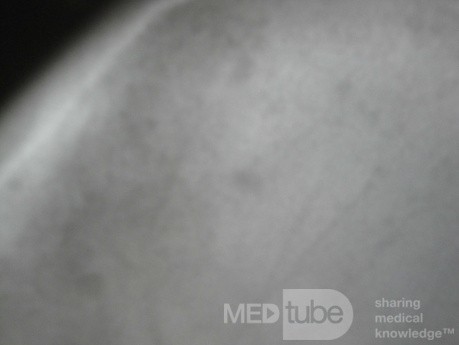 Colon Angiodysplasia and Multiple Myeloma (21 of 24)