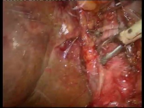 The Case of Cholecystoduodenal Fistula And Gallbladder Inflammation: One-Surgery Resolution