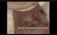 Endocervico Leep