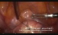 Laparoscopic Polymyomectomy - Tips and tricks. Live Surgery.