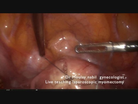 Laparoscopic Polymyomectomy - Tips and tricks. Live Surgery.