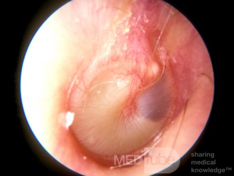 Mucoid Otitis Media [resolving]