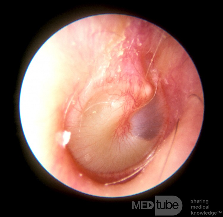 Mucoid Otitis Media [resolving]