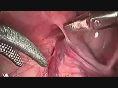 Laparoscopic Herniotomy