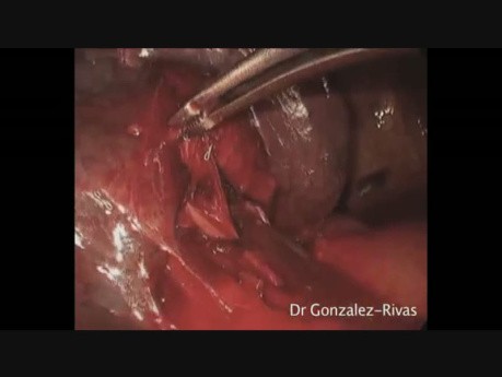 Hilar Tumor Single-Port Video-Assisted Thoracoscopic Anatomic Segmentectomy