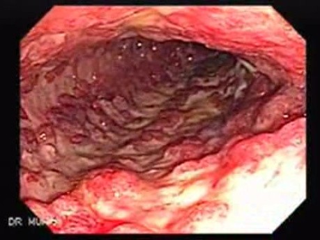 Multiple Rectal Ulcers (24 of 110)