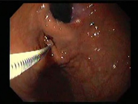 Gastric Varices - Endoscopic Ablation With Cyanoacrylate Glue (5 of 18)