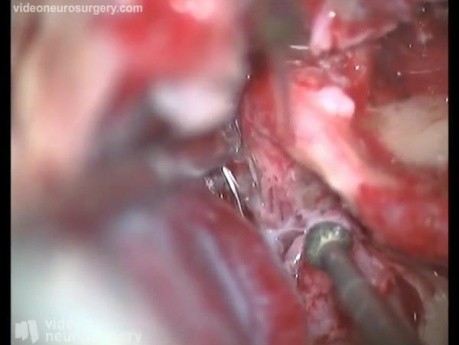 Right Facial Nerve Transposition Surgery - Posterior Rerouting