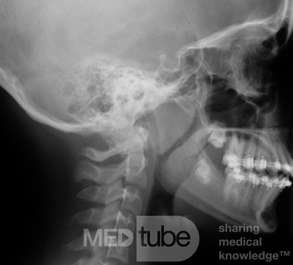 Lateral X-ray of a Patient with Enlarged Tonsils and Adenoids
