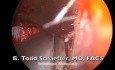 Endoscopic Rhinoplasty and Septoplasty
