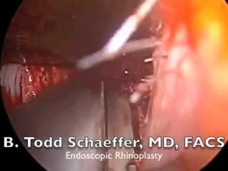 Endoscopic Rhinoplasty and Septoplasty
