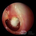 Otomycosis Superinfection