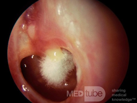 Otomycosis Superinfection