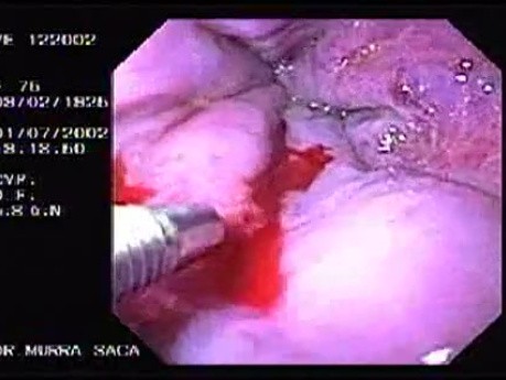 Hemorrhage due status post rubber band ligation of esophageal varices (10 of 25)