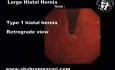Type 1 Hiatal Hernia - Retrograde View