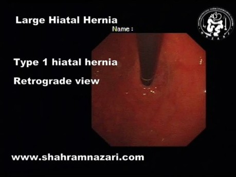 Type 1 Hiatal Hernia - Retrograde View