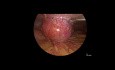 Laparoscopic Management of Port Site Abscess Secondary to Retained Gall Stone Following Laparoscopic Cholecystectomy