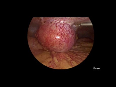 Laparoscopic Management of Port Site Abscess Secondary to Retained Gall Stone Following Laparoscopic Cholecystectomy