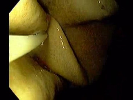 Balloon Removal (2 of 14)