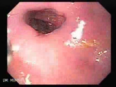 Esophageal Stricture After Total Gastrectomy And Chemoradiation - Application Of Mitomycin C - 1/2