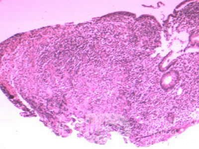 Multiple Rectal Ulcers (27 of 110)