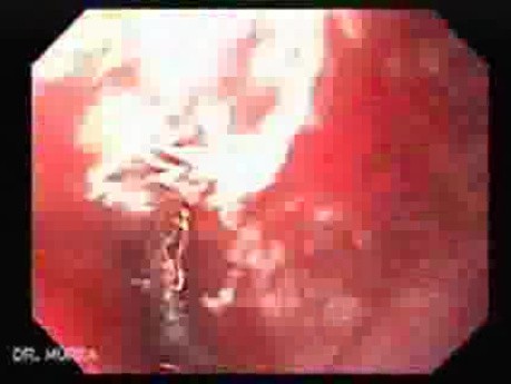 Severe Variceal Bleeding - Source of Bleeding