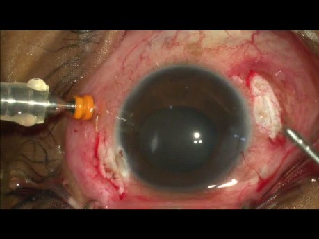 Traumatic Endophthelmitis Miracle From No Perception
