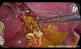 Biliary Peritonitis For Duct of Luschka Bile Leak After Laparoscopic Cholecystectomy