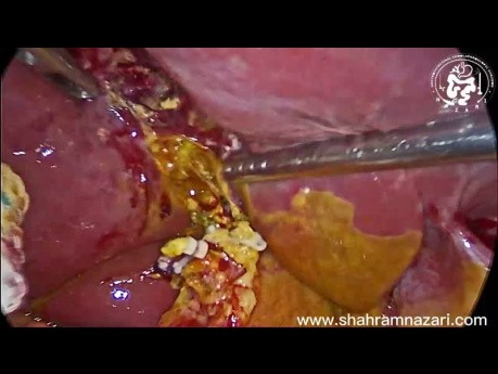 Biliary Peritonitis For Duct of Luschka Bile Leak After Laparoscopic Cholecystectomy