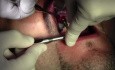 Implant Surgery #6 - Legacy-Implant Direct, Mineross Regenerated Bone