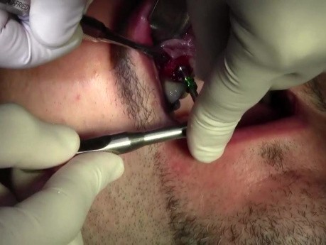 Implant Surgery #6 - Legacy-Implant Direct, Mineross Regenerated Bone