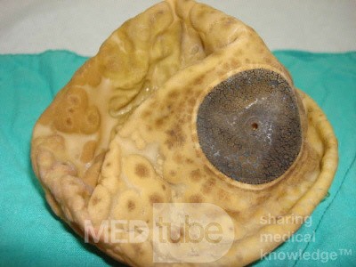 Intragastric Balloon Deteriorotated By Gastric Acid (1 of 3)