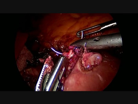 Redo-Surgery: from Verrtical Gastroplasty to RYGPB with Fobi Ring