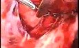 Laparoscopic Myomectomy Included In The Broad Ligament