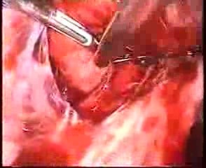 Laparoscopic Myomectomy Included In The Broad Ligament