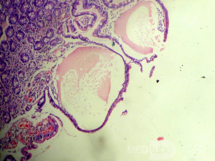Duodenal lymphangiectasia (6 of 7)