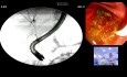 5 Things That Make Post-cholecystectomy ERCP Look Easy (And 5 That Ruin It)