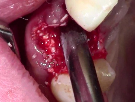 Tooth Extraction With Simple Socket Grafting