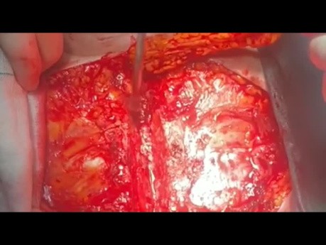 Patient with CVA and Biatrial Mass Undergone Surgery 