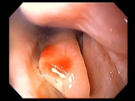 Massive Epistaxis - 76-year-old female patient - 1/8