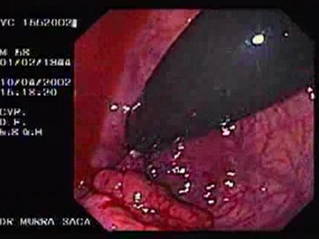 Rectal Cancer That Emerges In The Pectin Line (2 of 3)