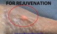 Skin rejuvenation - cold laser treatment