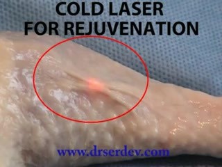 Skin rejuvenation - cold laser treatment